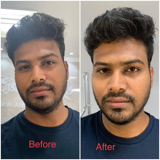 Before and After 1